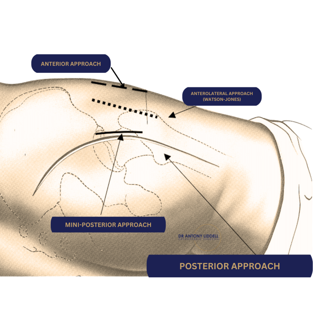 hip replacement surgical approaches