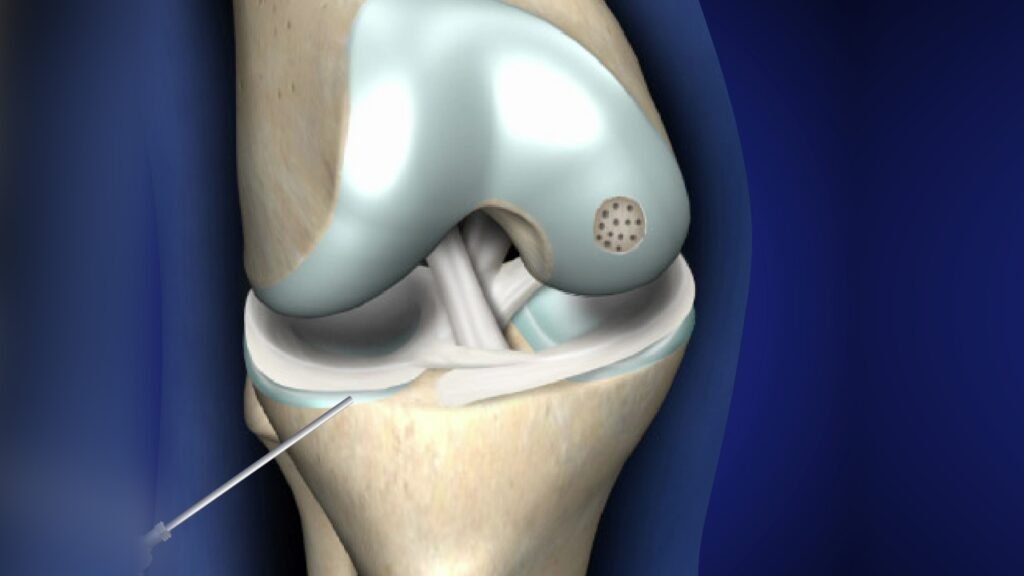 Microfracture
