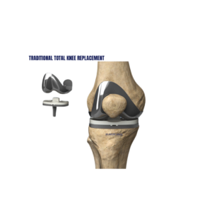 Traditional total knee replacement surgery